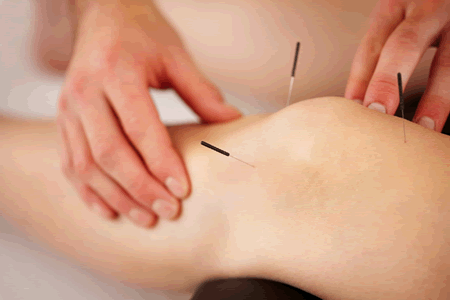 acupuncture