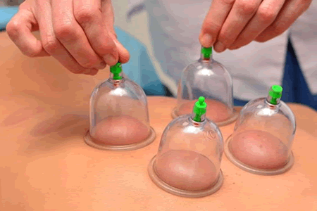 cupping